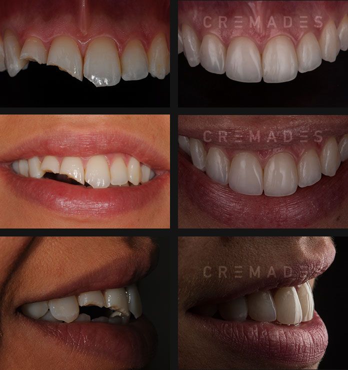 Foto caso reconstrucción dientes fracturados - carillas de composite