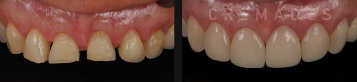 Foto caso rejuvenecimiento dental - carillas de composite