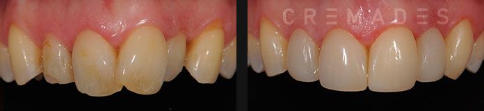 Foto caso apiñamiento dental - carillas de composite
